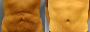 Patient B Body Lift Before and After