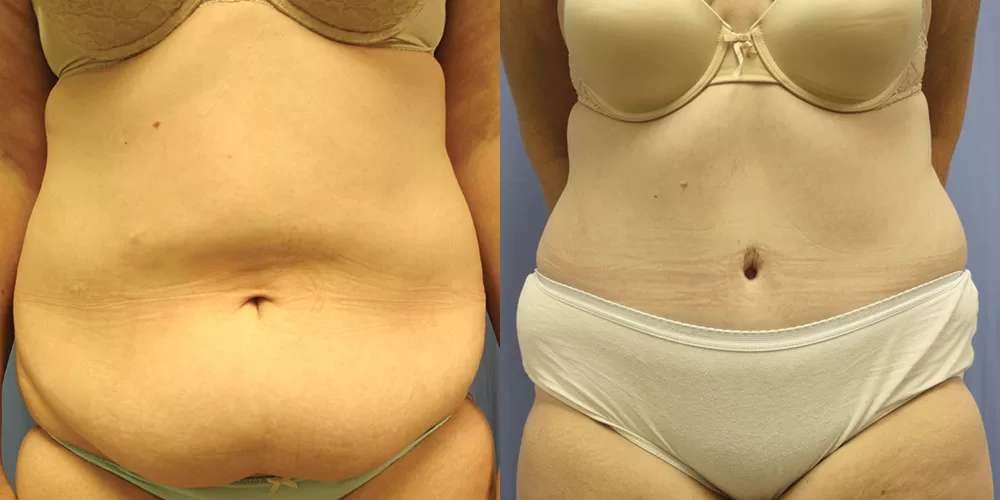 Moratis plastic surgery tummy tuck patient 21a