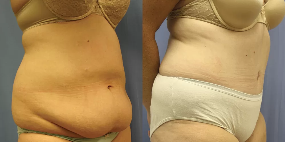 Moratis plastic surgery tummy tuck patient 21b