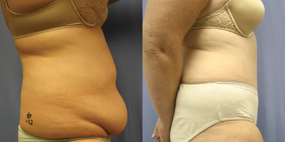 Moratis plastic surgery tummy tuck patient 21c