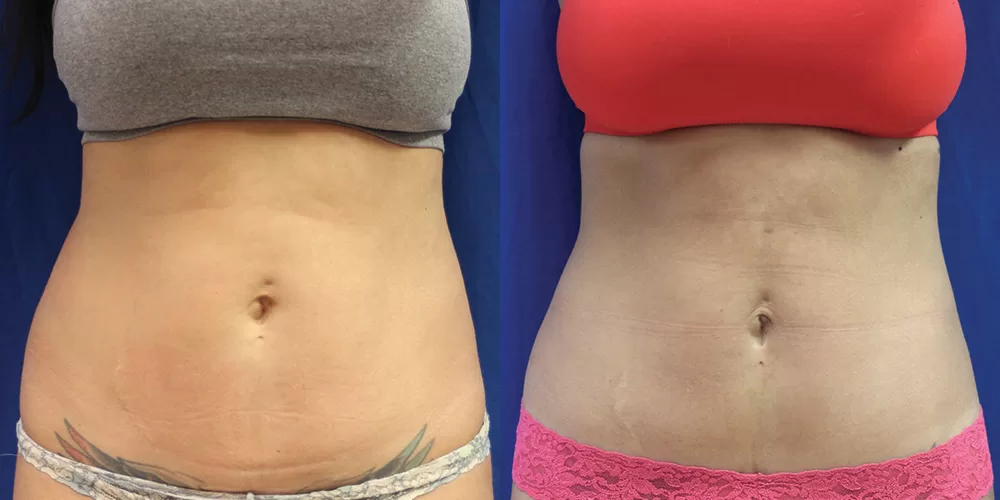 Moratis plastic surgery tummy tuck patient 22a