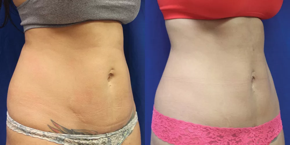 Moratis plastic surgery tummy tuck patient 22b