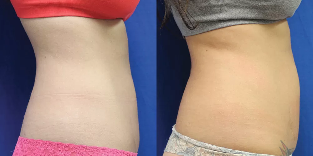 Moratis plastic surgery tummy tuck patient 22c