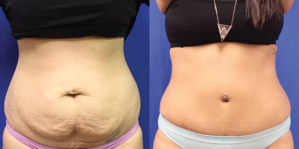 Moratis plastic surgery tummy tuck patient 23a