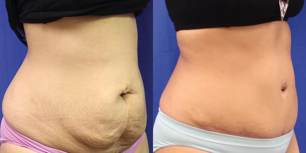 Moratis plastic surgery tummy tuck patient 23b