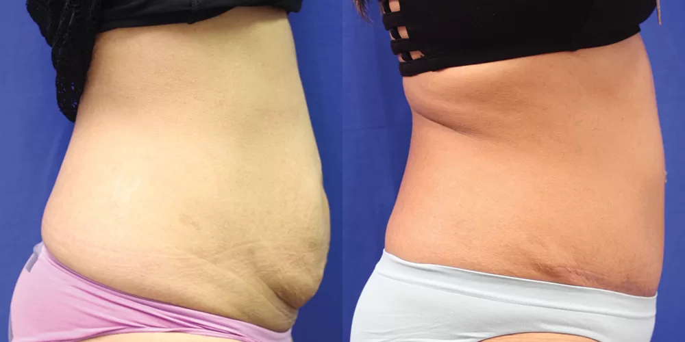 Moratis plastic surgery tummy tuck patient 23c