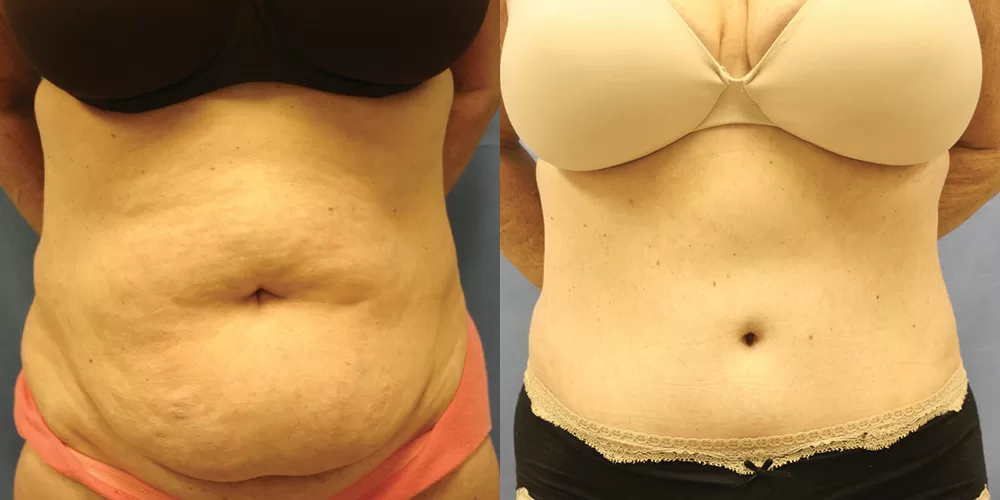 Moratis plastic surgery tummy tuck patient 24a