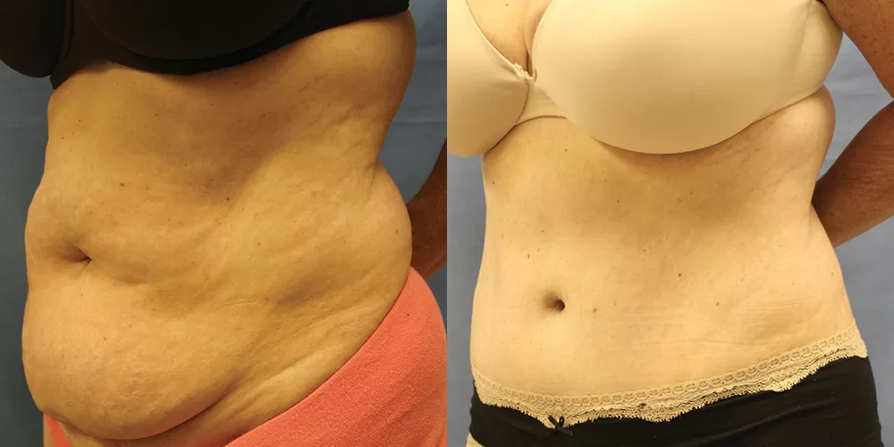 Moratis plastic surgery tummy tuck patient 24b