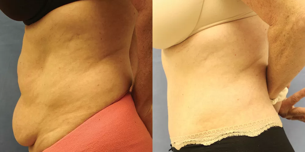 Moratis plastic surgery tummy tuck patient 24c