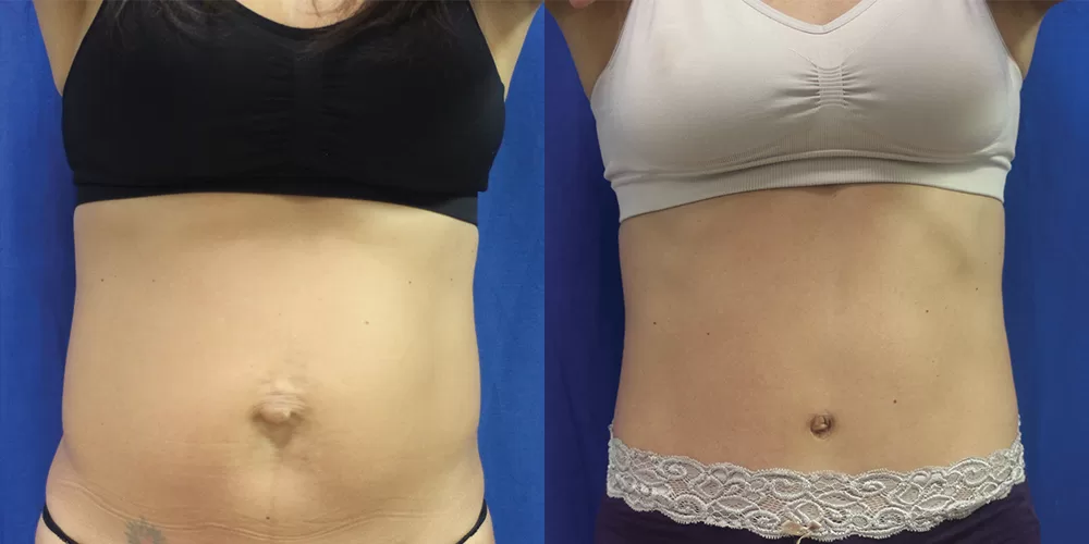 Moratis plastic surgery tummy tuck patient 25a