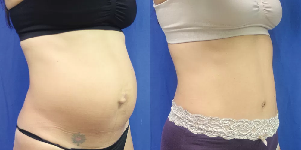 Moratis plastic surgery tummy tuck patient 25b