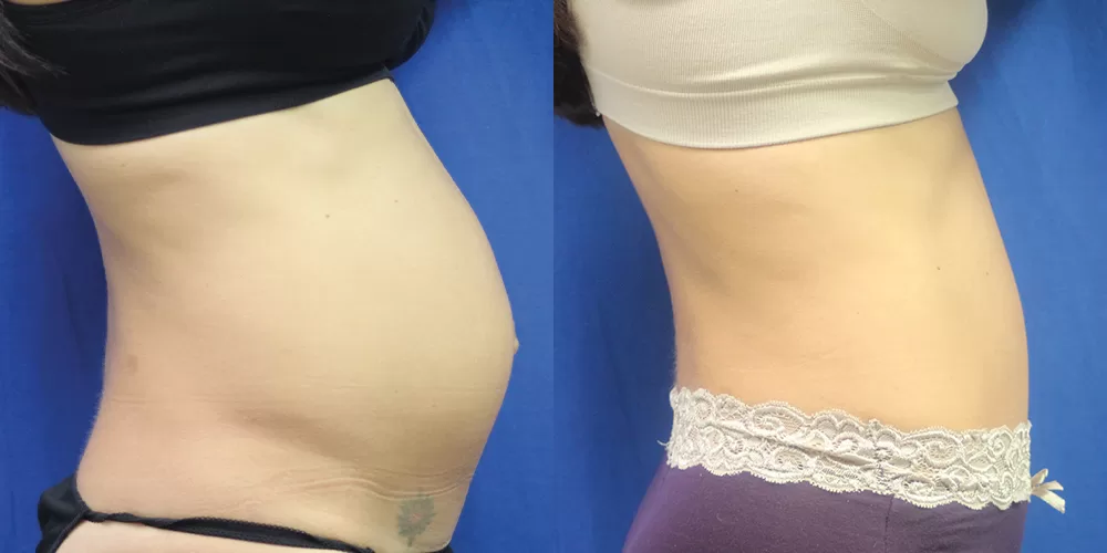 Moratis plastic surgery tummy tuck patient 25c
