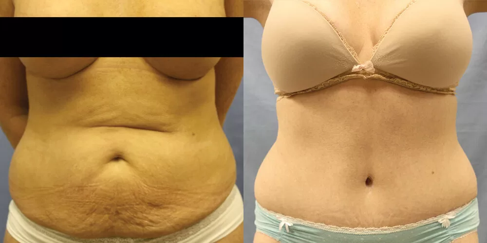 Moratis plastic surgery tummy tuck patient 26a