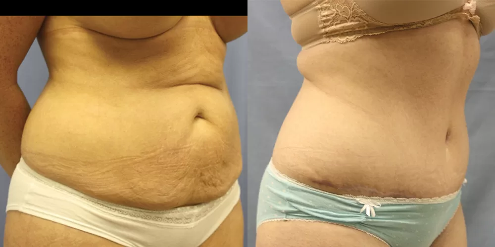 Moratis plastic surgery tummy tuck patient 26b