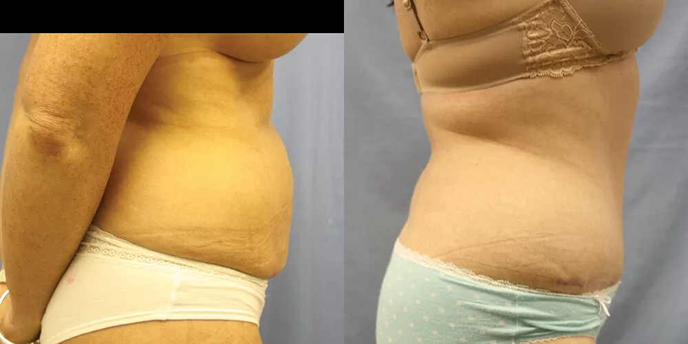 Moratis plastic surgery tummy tuck patient 26c
