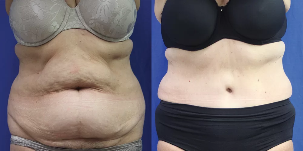 Moratis plastic surgery tummy tuck patient 27a