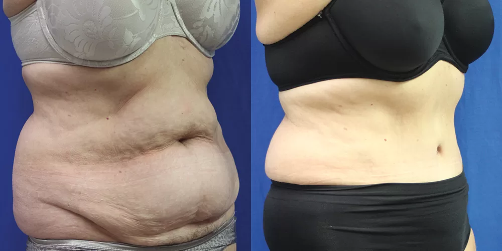 Moratis plastic surgery tummy tuck patient 27b