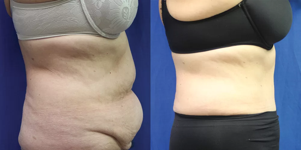 Moratis plastic surgery tummy tuck patient 27c