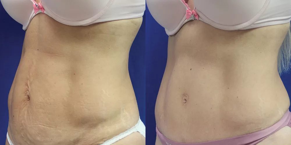 Moratis plastic surgery tummy tuck patient 28b