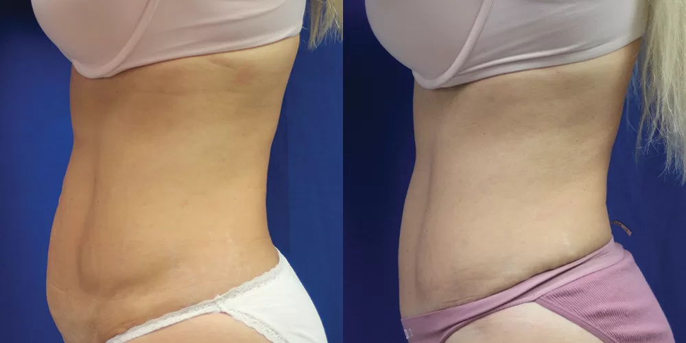 Moratis plastic surgery tummy tuck patient 28c