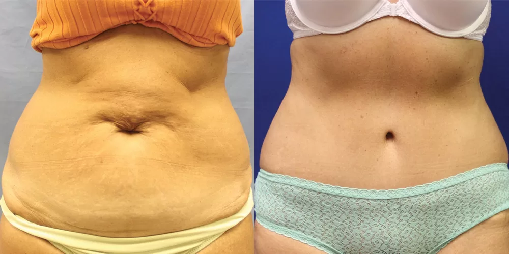 Moratis plastic surgery tummy tuck patient 29a