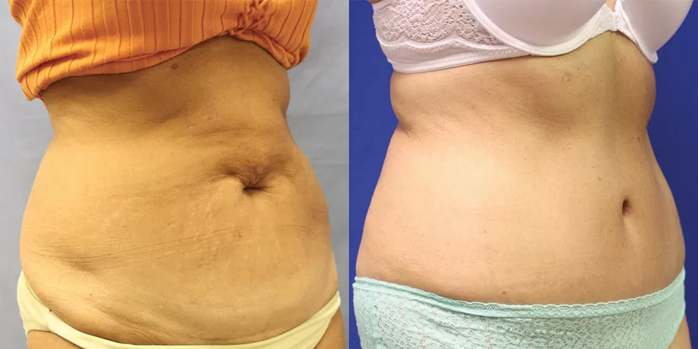 Moratis plastic surgery tummy tuck patient 29b