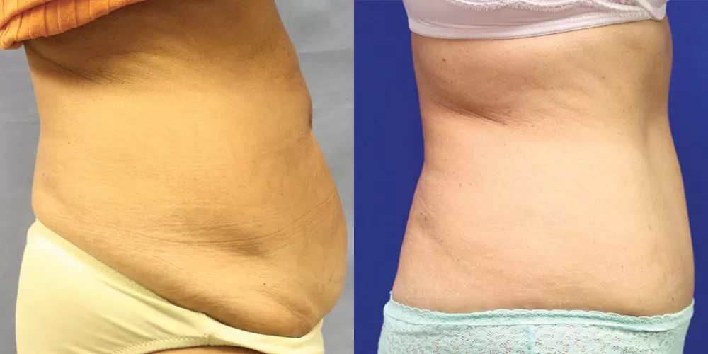 Moratis plastic surgery tummy tuck patient 29c
