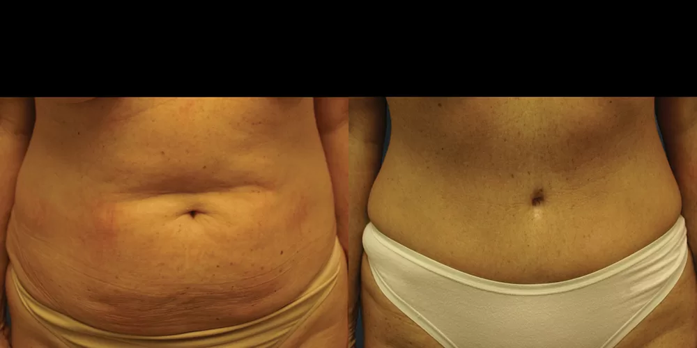 Moratis plastic surgery tummy tuck patient 30a