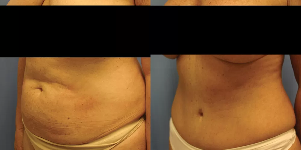 Moratis plastic surgery tummy tuck patient 30b