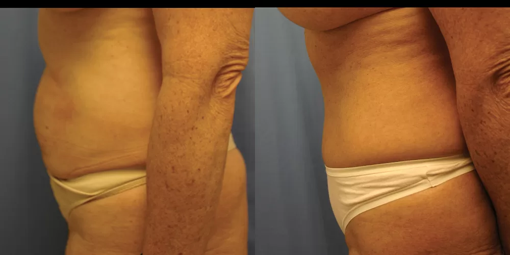 Moratis plastic surgery tummy tuck patient 30c