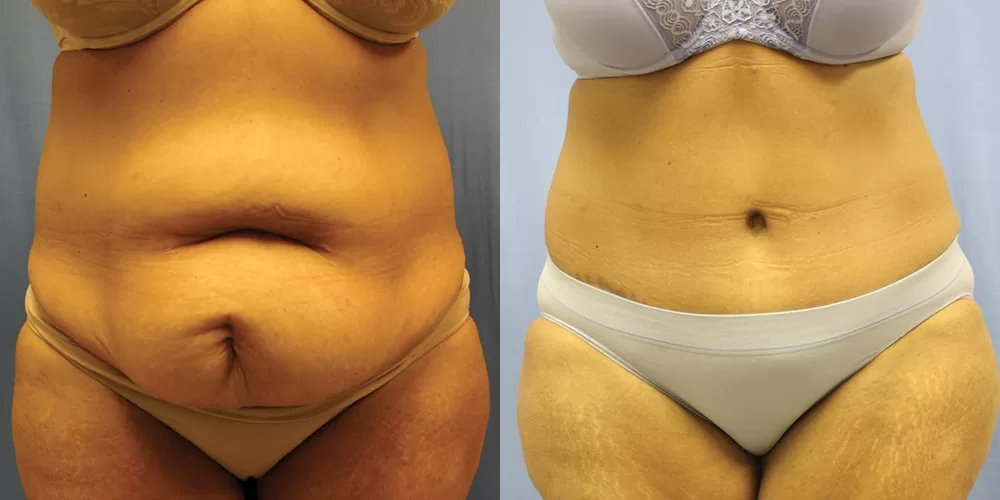 Moratis plastic surgery tummy tuck patient 31a