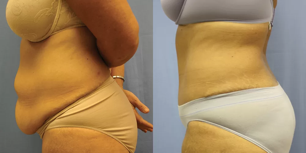Moratis plastic surgery tummy tuck patient 31c