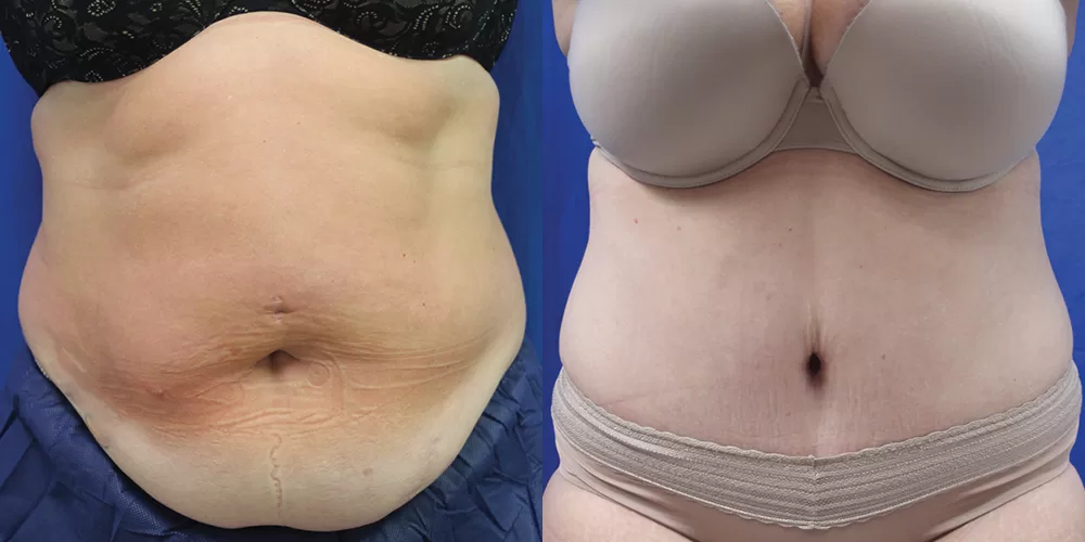 Moratis plastic surgery tummy tuck patient 32a
