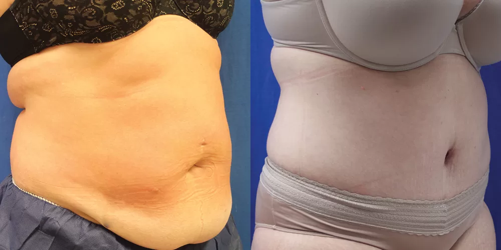 Moratis plastic surgery tummy tuck patient 32b
