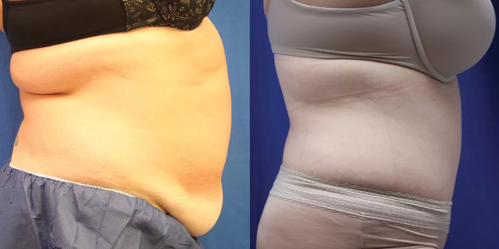 Moratis plastic surgery tummy tuck patient 32c