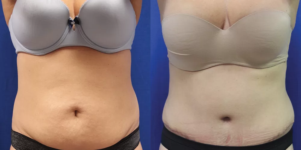 Moratis plastic surgery tummy tuck patient 33a