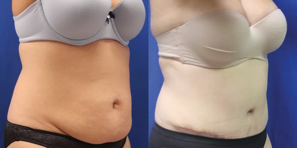 Moratis plastic surgery tummy tuck patient 33b