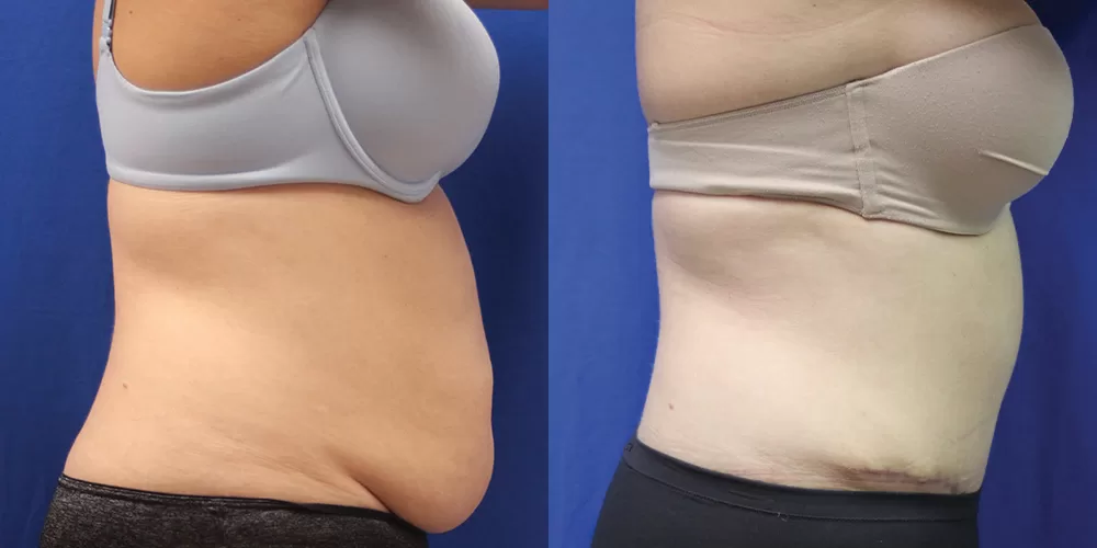 Moratis plastic surgery tummy tuck patient 33c