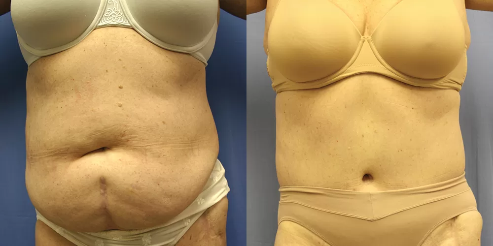 Moratis plastic surgery tummy tuck patient 34a