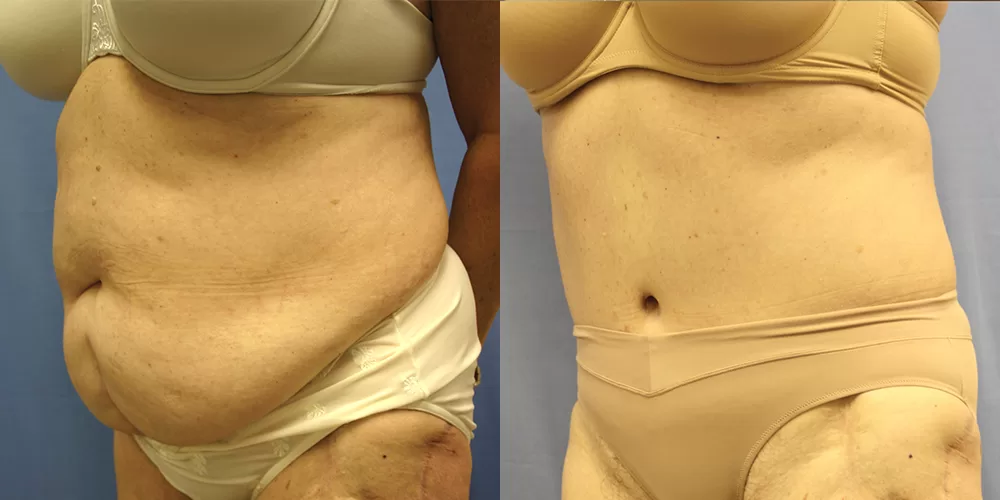 Moratis plastic surgery tummy tuck patient 34b