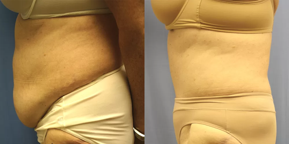 Moratis plastic surgery tummy tuck patient 34c