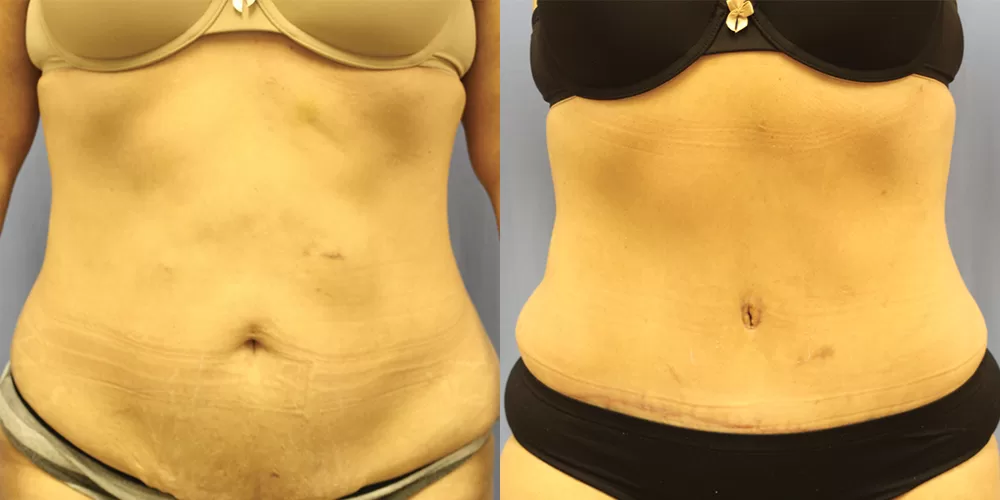 Moratis plastic surgery tummy tuck patient 35a