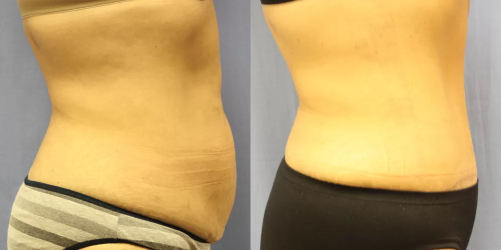 Moratis plastic surgery tummy tuck patient 35c
