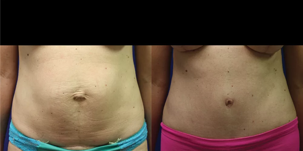 Moratis plastic surgery tummy tuck patient 36a