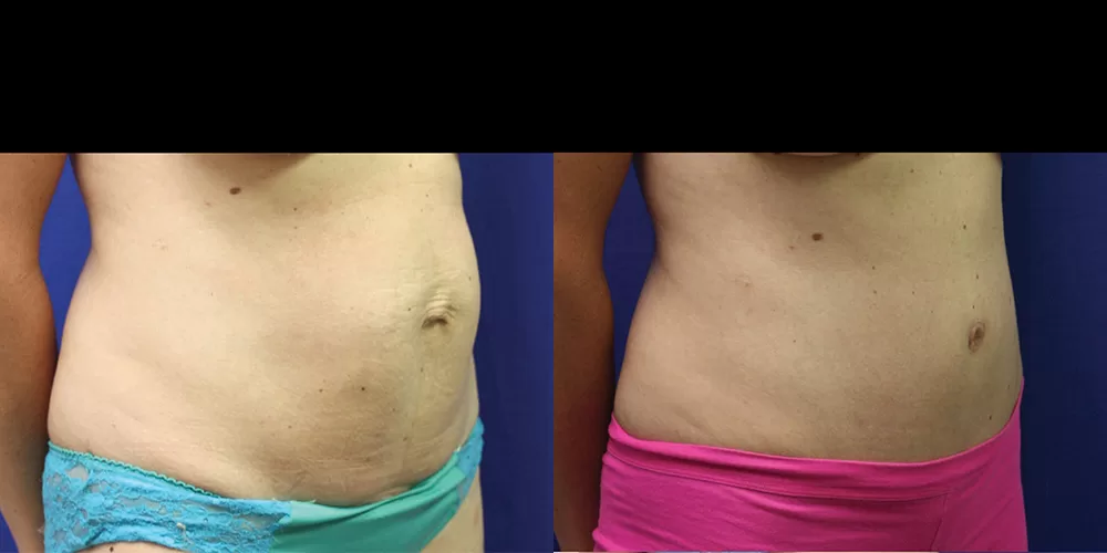 Moratis plastic surgery tummy tuck patient 36b