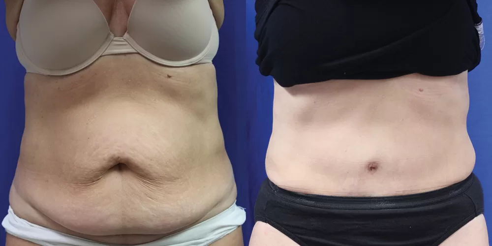 Moratis plastic surgery tummy tuck patient 37a