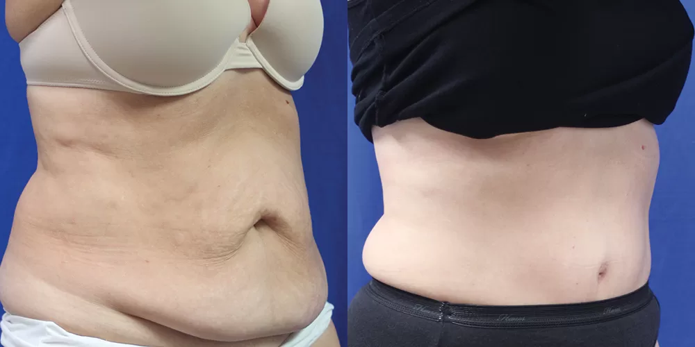 Tummy tuck patient