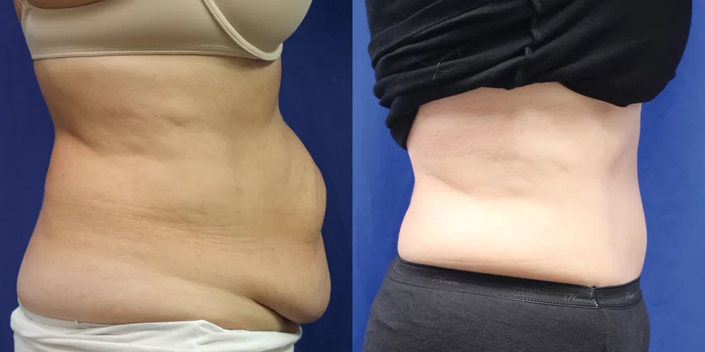 Moratis plastic surgery tummy tuck patient 37c