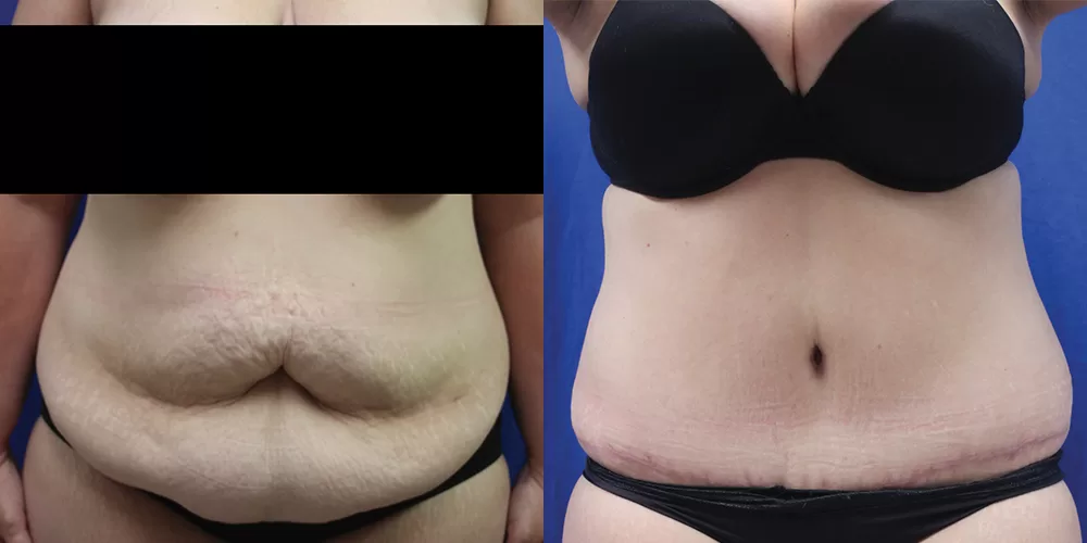 Moratis plastic surgery tummy tuck patient 38a