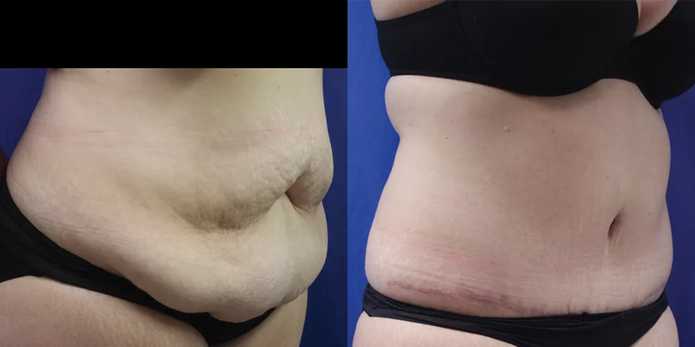 Moratis plastic surgery tummy tuck patient 38b